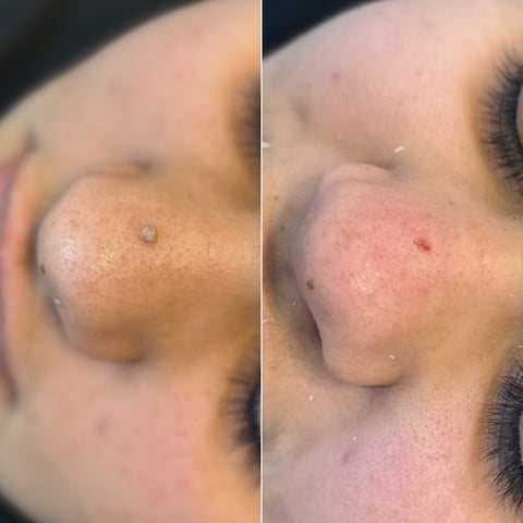 Before and after comparison of a skin lesion or mole removal treatment on the shoulder area