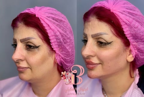 Before and after profile comparison showing facial contouring results with pink head covering