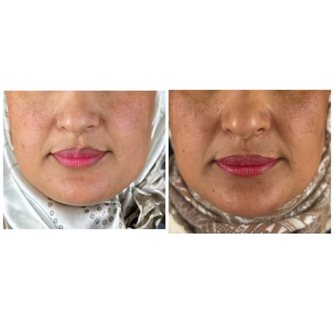 Before and after lip augmentation treatment showing enhanced lip volume and definition on female patient