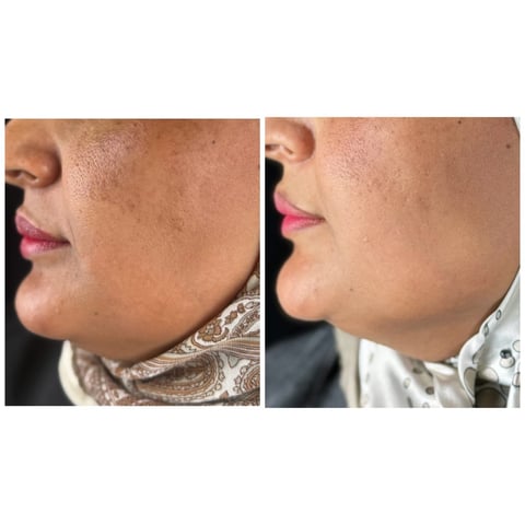 Before and after side profile comparison showing jawline and chin definition improvement
