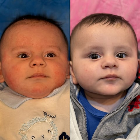 Side-by-side photos of an infant showing redness on left side and cleared skin on right side against blue and pink backgrounds