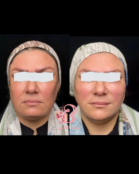 Before and after facial comparison showing a woman with reduced forehead wrinkles and smoother skin texture on the right image