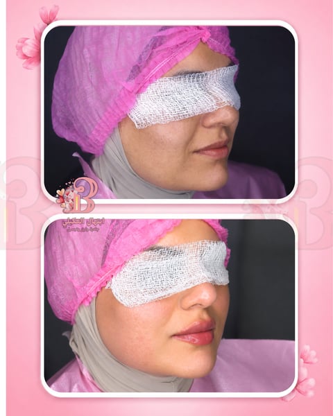 Before and after cosmetic surgery results showing a patients face with pink surgical cap and white bandages covering the eyes and forehead