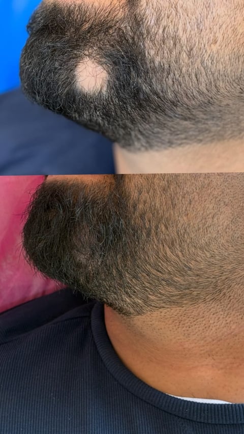 Close-up of mans beard and jaw showing dark facial hair growth against blue and pink backgrounds