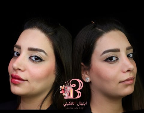 Before and after facial contouring results showing side profile comparison of a woman with enhanced cheekbones and refined features