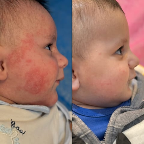 Before and after comparison showing infants face with rash on left, cleared skin on right against blue and pink backgrounds